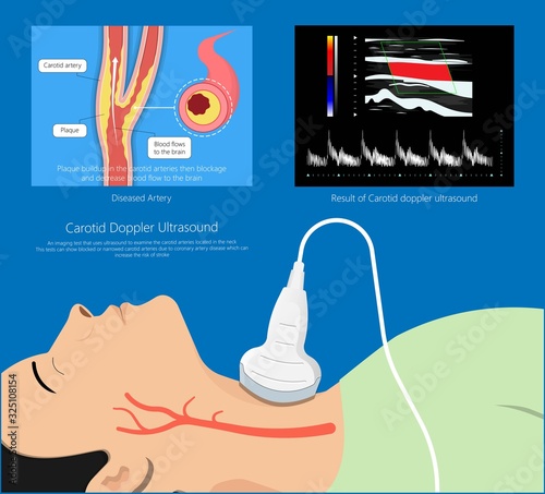 Coronary artery disease CAD diagnosis treatment