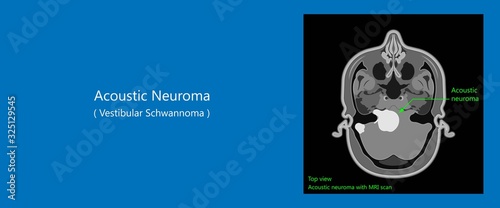 Acoustic Neuroma ear exam diagnose nerve treat