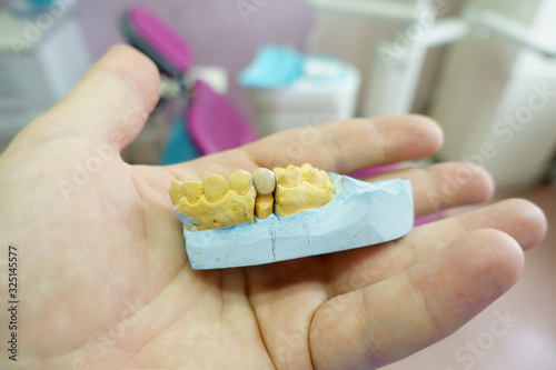 close-up ceramic tooth crown on a plaster model of teeth in the dentist's hand