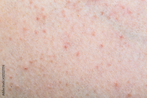 A close up shot of an allergic skin