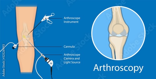 Arthroscopy medical treatment surgery keyhole surgical treat endoscope photo