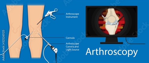 Arthroscopy medical treatment surgery keyhole surgical treat endoscope