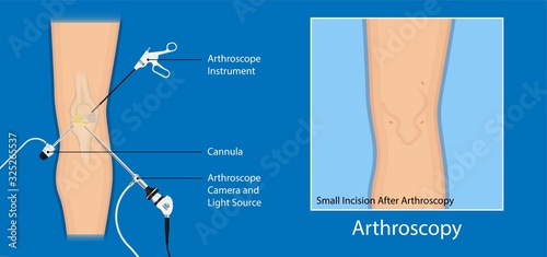 Arthroscopy medical treatment surgery keyhole surgical treat endoscope