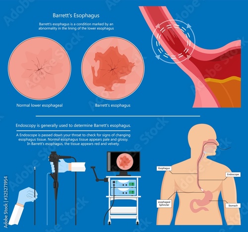 Barrett's esophagus acid lower risk cells dysplasia treat diagnosis