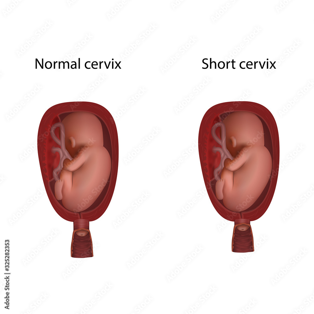 Short cervix in pregnancy and normal. Fetus in uterus, womb, placenta