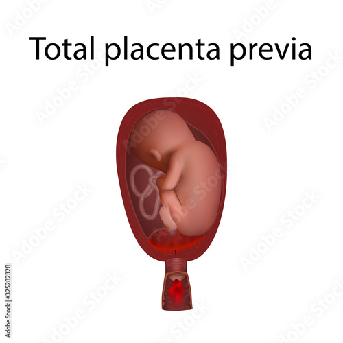 Total placenta previa. Fetus in uterus, womb, umbilical cord. Hi-risk pregnancy complications. Medical anatomy illustration. photo