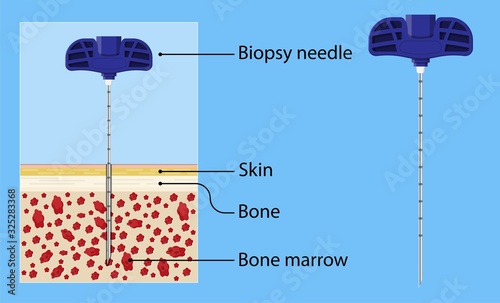 Bone biopsy medical marrow harvest stem cell transplants aspiration specimen cancer procedure sample test treatment diagnosis anemia blood cell lab