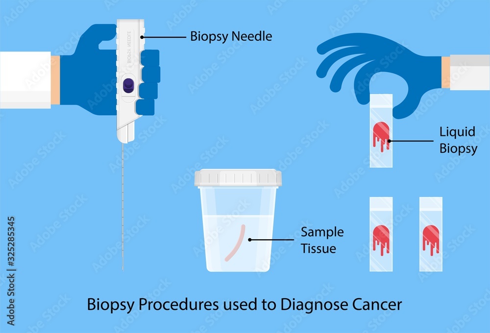 Breast biopsy medical Fine Needle Aspiration FNA diagnostic lab