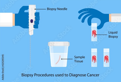 Breast biopsy medical Fine Needle Aspiration FNA diagnostic lab laboratory screening exam Ultrasound Guided lump tumor cell tissue imaging test cancerous core