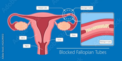 Hysterosalpingogram HSG Test Blocked Fallopian Tubes diagnose tubal factor infertility pregnant trouble certain sexually transmitted structural abnormalities uterine exam liquid fluoroscope cancer in