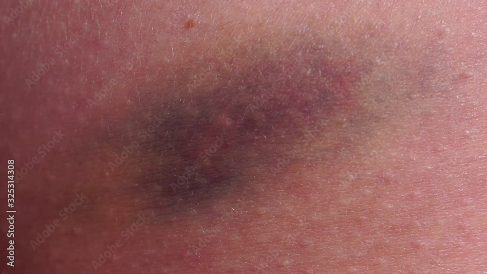 bruise on a man's arm in close-up on a black background. bruises, shock, human skin macro, selective focus bruise on a man's arm in close-up on a black background. bruises, shock, human skin macro, selective focus