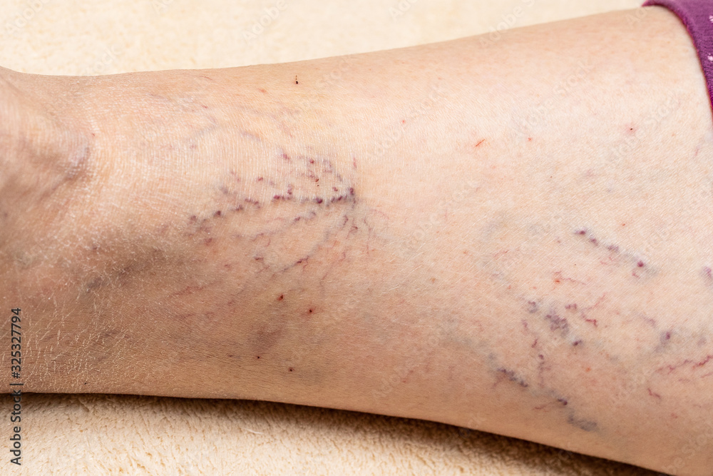 Naklejka premium Varicose veins in a lady's leg. Abnormal and saccular dilations of the veins.