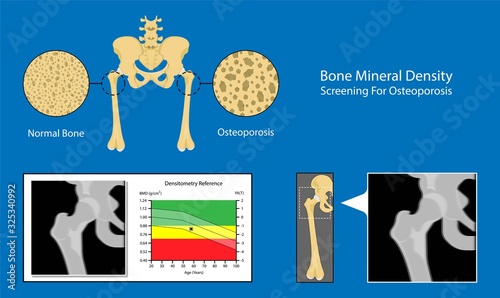Bone mineral density BMD osteoporosis dual energy X-ray absorptionmetry adult disease equipment medical clinic central DXA pain radiography hospital fragility risk examine