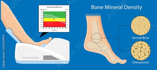 Bone mineral density BMD osteoporosis dual energy X-ray absorptionmetry adult disease equipment medical clinic central DXA pain radiography hospital fragility risk examine photo