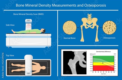 Bone mineral density BMD osteoporosis dual energy X-ray absorptionmetry adult disease equipment medical clinic central DXA pain radiography hospital fragility risk examine
