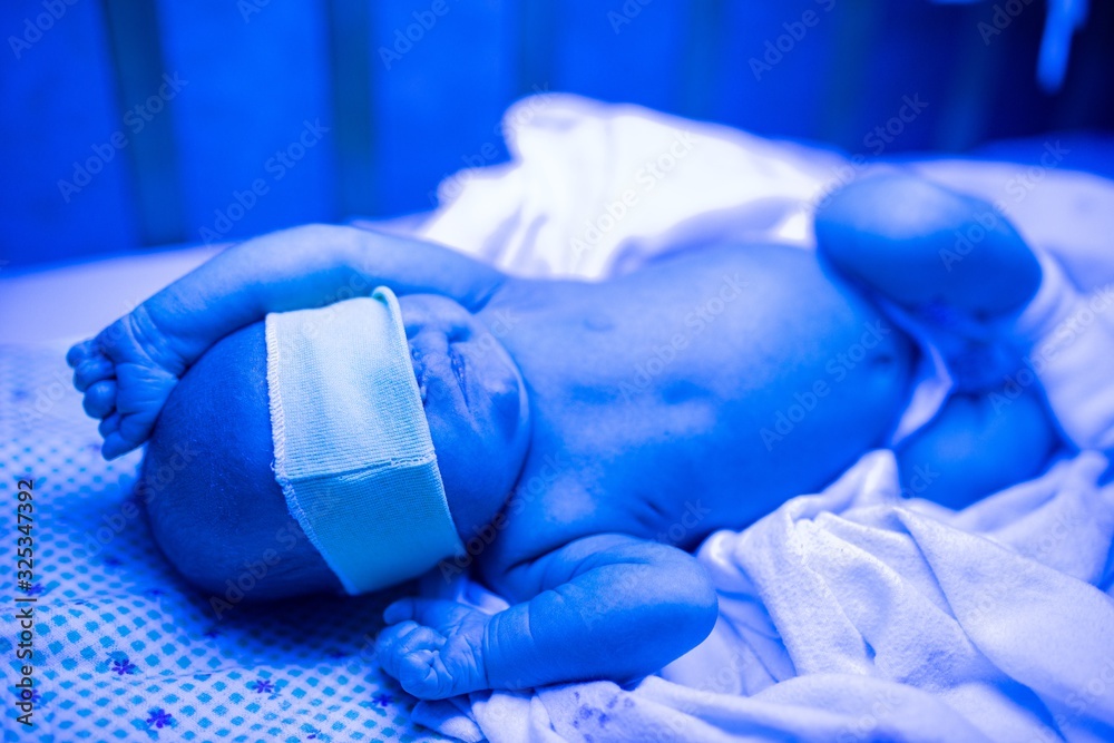 Foto de Newborn having a treatment for jaundice under ultraviolet light