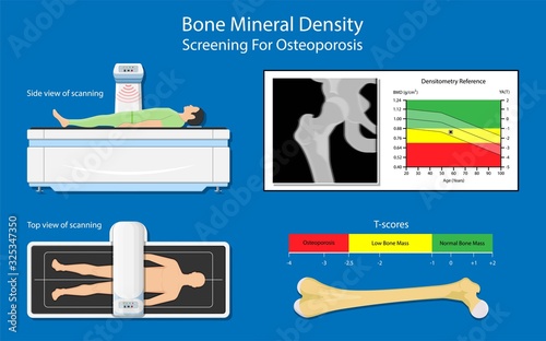 Bone mineral density BMD osteoporosis dual energy X-ray absorptionmetry adult disease equipment medical clinic central DXA pain radiography hospital fragility risk examine photo