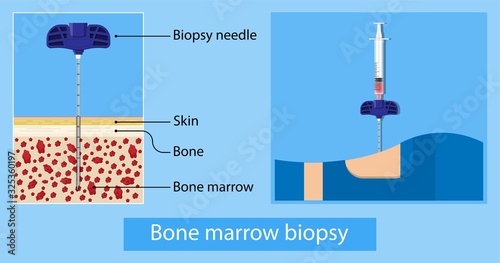 Bone biopsy medical marrow harvest stem cell transplants aspiration specimen cancer procedure sample test treatment diagnosis anemia blood cell lab