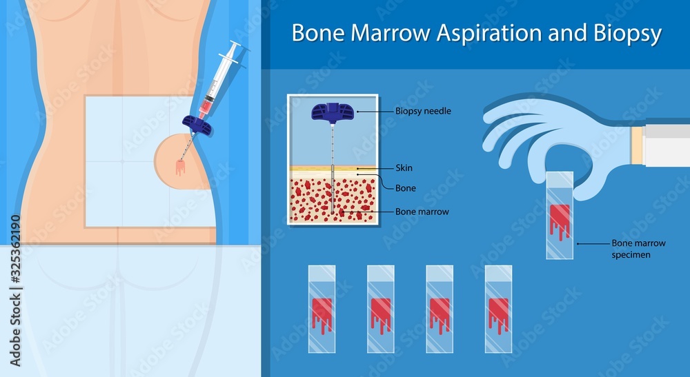 Bone biopsy medical marrow harvest stem cell transplants aspiration  specimen cancer procedure sample test treatment diagnosis anemia blood cell  lab vector de Stock | Adobe Stock