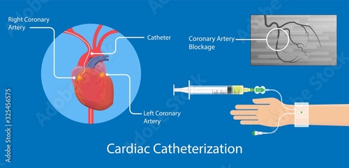 Angiography medical treatment Cardiac operation Angiogram Biopsy Angioplasty Stent Congenital Heart Defect Ablation CAG arteries cholesterol plaque attack  X-ray blood flow diagnose diagnosis blocked
