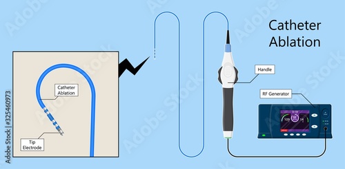 attack Cardiac catheter ablation Atrial fibrillation minimally invasive procedure rhythm problem cath lab treat treatment Coronary x-ray Radio frequency Sinus Ventricular SVT ECG ICD Radiofrequency AV