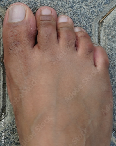 Close up of women's foot isolated on a concrete floor background. Foot is ugly, dark brown and it has hair and veins showing. No manicure. unmanicured nails. photo