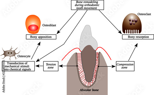 Bone remodeling during orthodontic tooth movement. Types of cells that participate during this bone remodeling process. This vector is useful for brochures, printed book, ebook, digital book, etc.