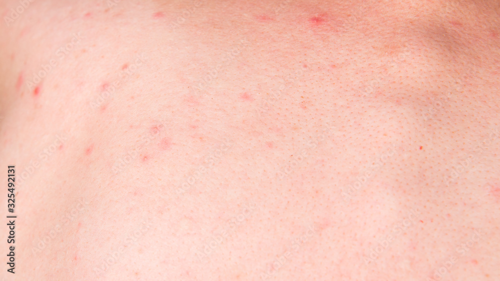 Red acne on the skin of the back of a young woman Red acne on the skin of the back of a young woman