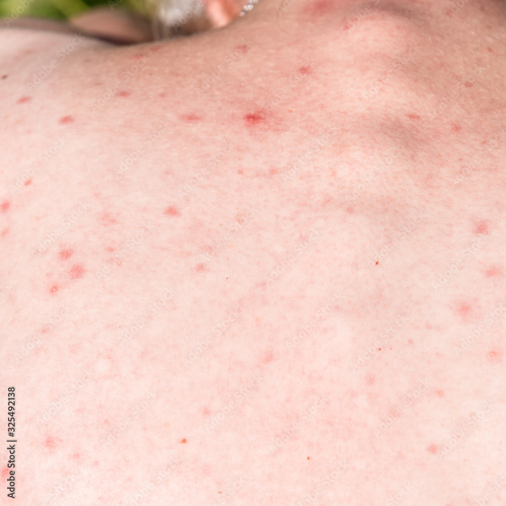 Red acne on the skin of the back of a young woman