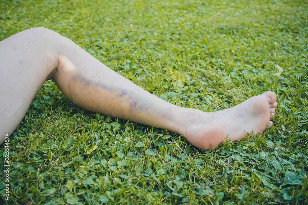 Leg of a woman with visible big blue and yellow bruise on calf muscle