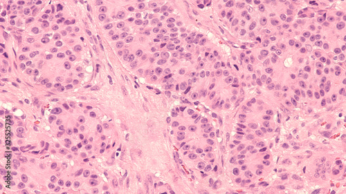 Prostate Cancer Oncology Awareness: Photomicrograph of core biopsy of prostate gland showing histology of prostatic adenocarcinoma with prominent nucleoli in patient with elevated PSA.  photo