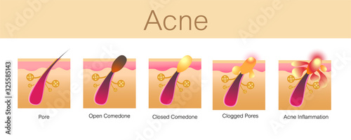 Acne,stages of development,healthy skin,vector design
