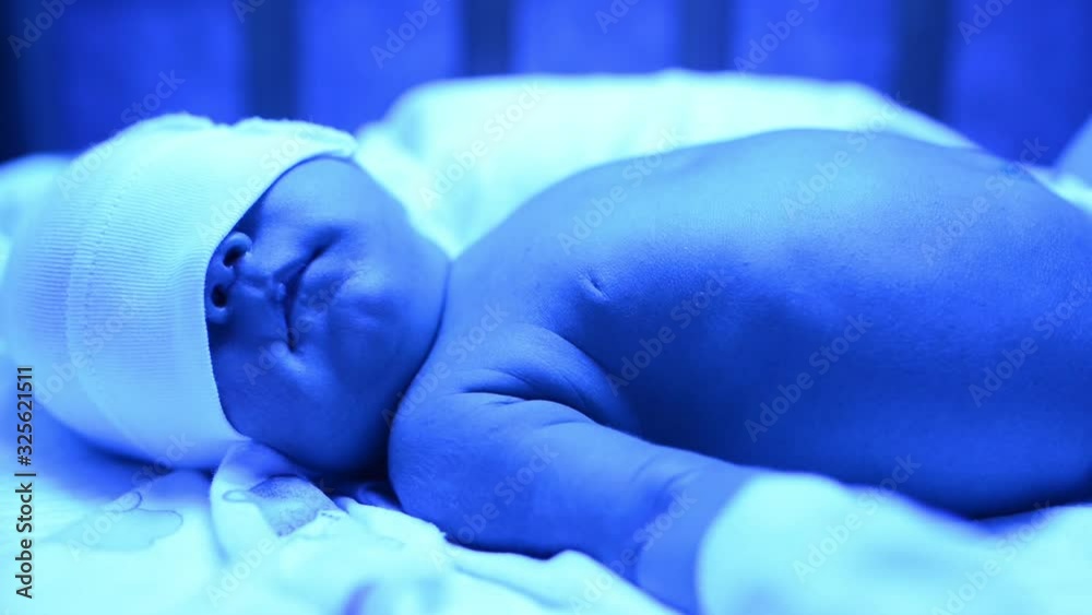 Newborn having a treatment for jaundice under ultraviolet light, Baby has high level of