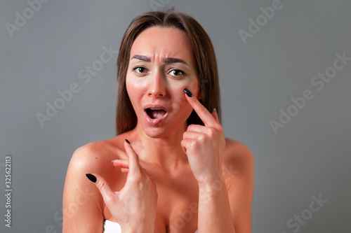The concept of sunburn. The young woman points a distressed finger at her sun-reddened face. Gray background. Copy space photo