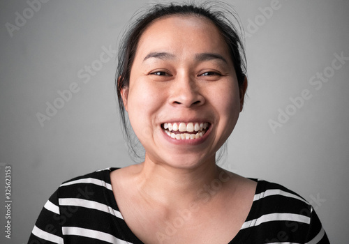 Fotografie Smiling woman's teeth revealing  white spots and plaque on the tooth surface with abnormal tooth structure, The lower teeth protrude to the front