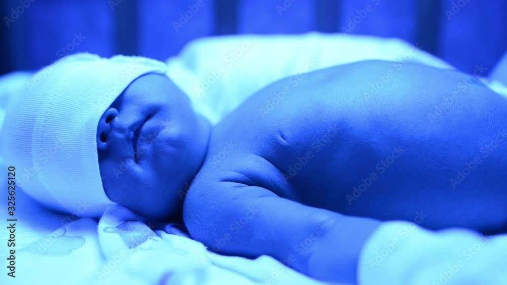Newborn having a treatment for jaundice under ultraviolet light, Baby has high level of