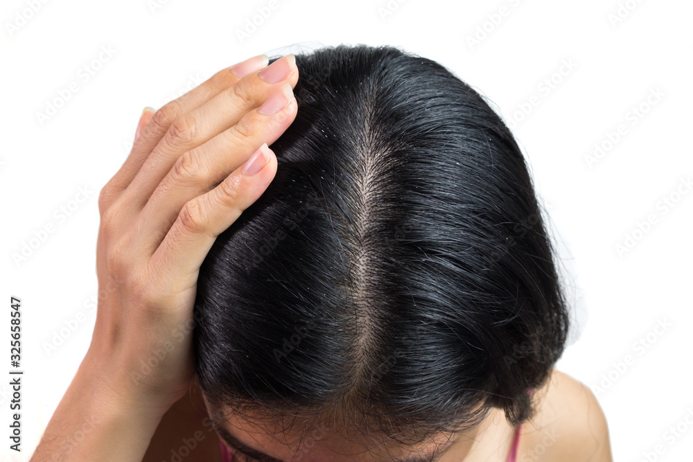 women head with dandruff Caused by the problem of dirty. Or caused by skin disease or Seborrheic Dermatitis. It has white scaly and it will cause itch. isolated on white background and clipping path. women head with dandruff Caused by the problem of dirty. Or caused by skin disease or Seborrheic Dermatitis. It has white scaly and it will cause itch. isolated on white background and clipping path.
