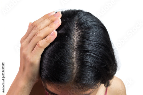 women head with dandruff Caused by the problem of dirty. Or caused by skin disease or Seborrheic Dermatitis. It has white scaly and it will cause itch. isolated on white background and clipping path.