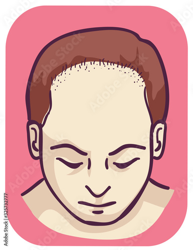 Male Pattern Baldness Frontal Hair Loss