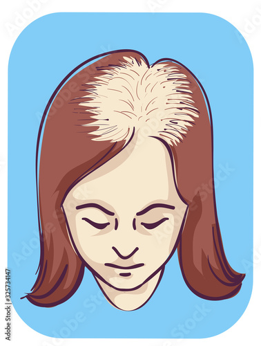 Girl Female Pattern Baldness Top Area Illustration