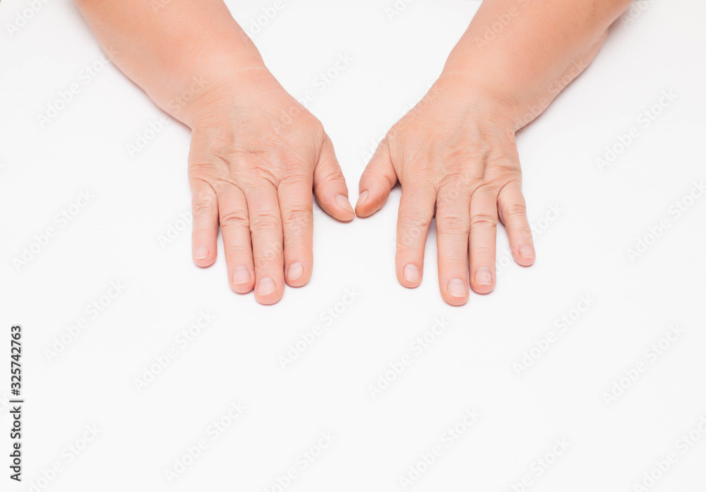 Dry skin with wrinkles on the hands of an elderly woman, white background, isolate. Fragility of blood vessels, vitamin deficiency, copy space Dry skin with wrinkles on the hands of an elderly woman, white background, isolate. Fragility of blood vessels, vitamin deficiency, copy space