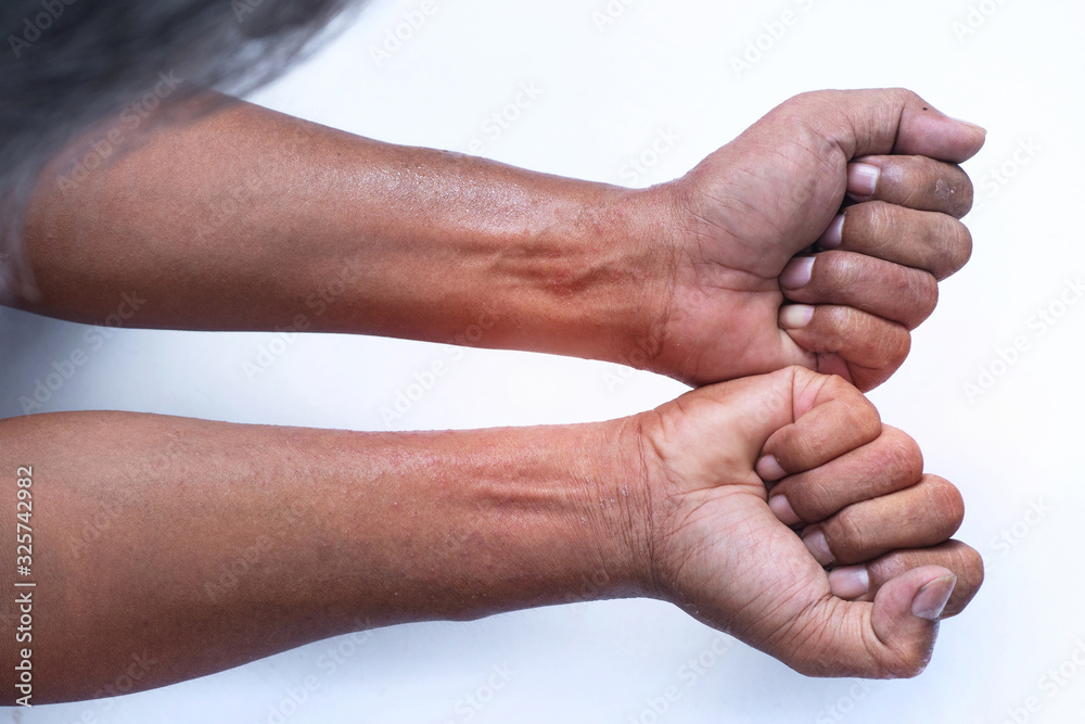 Erythematous rashes on the man wrists, papules and plaque, small macula redness and itchiness