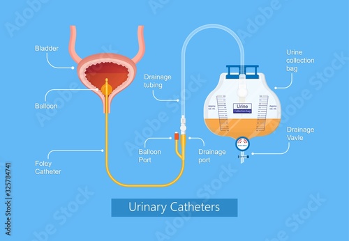 Urine bag medical treatment drainage bladder rubber flexible body infection bacteria output measure tract toilet leg relieve cancer device calculi vesical problem anatomy sterile surgical urethra