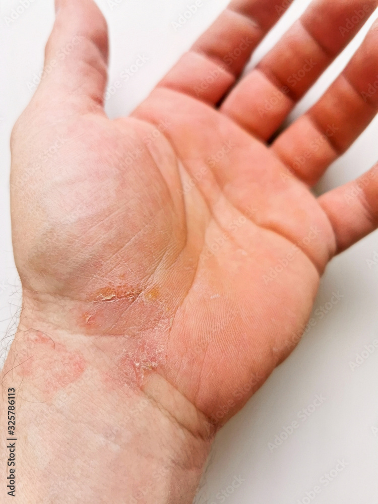 trockene rissige Haut - Dry cracked skin on Hand Stock Photo | Adobe Stock