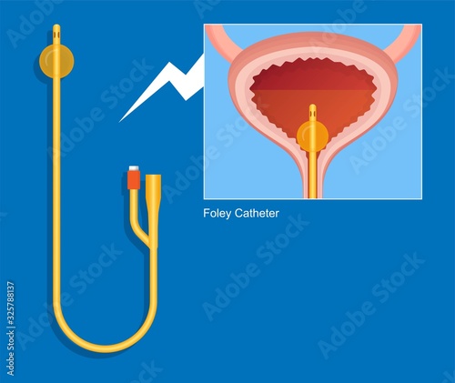 Urine bag medical treatment drainage bladder rubber flexible body infection bacteria output measure tract toilet leg relieve cancer device calculi vesical problem anatomy sterile surgical urethra