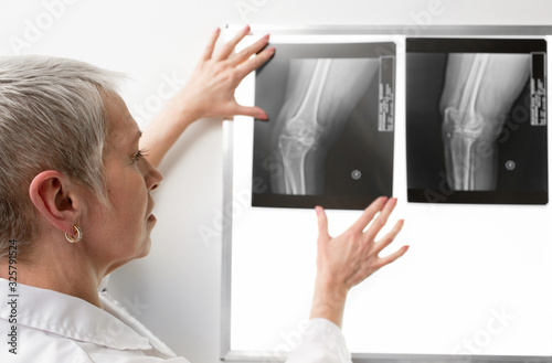 Radiologist examines a knee x-ray on a negatoscope. X-ray doctor sees ligament on patient's knee photo