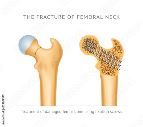 The fracture of femoral neck. Treatment of damaged femur bone neck using fixation screws