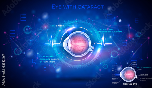 Eye with cataract, vision disorder