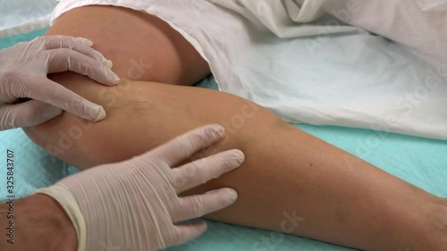 doctor examines a patient's leg before sclerotherapy for varicose veins