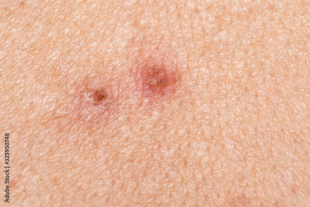Fototapeta premium Teenage skin with acne problems, two manually broken pimples that formed the crust with risk of infection